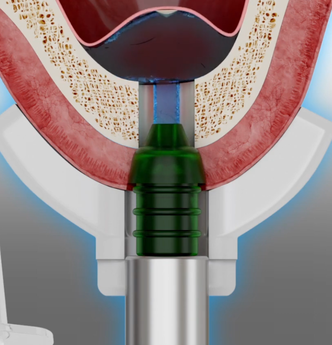 Balloon sinus lift