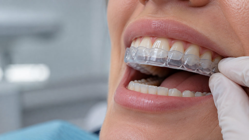 Placa oclusal impressa ou fresada: o que a evidência mostra sobre desgaste