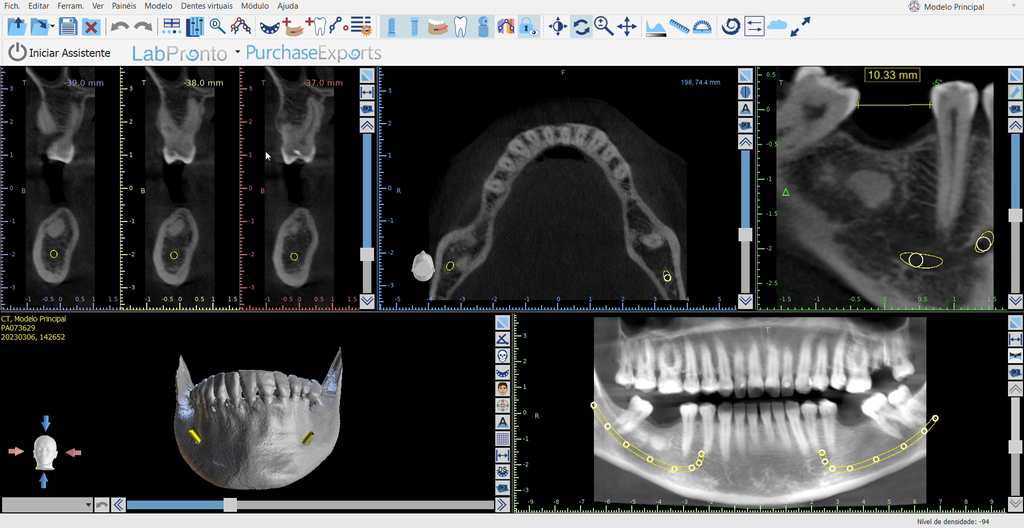 Fluxo digital em cirurgia guiada: as etapas e onde o erro entra